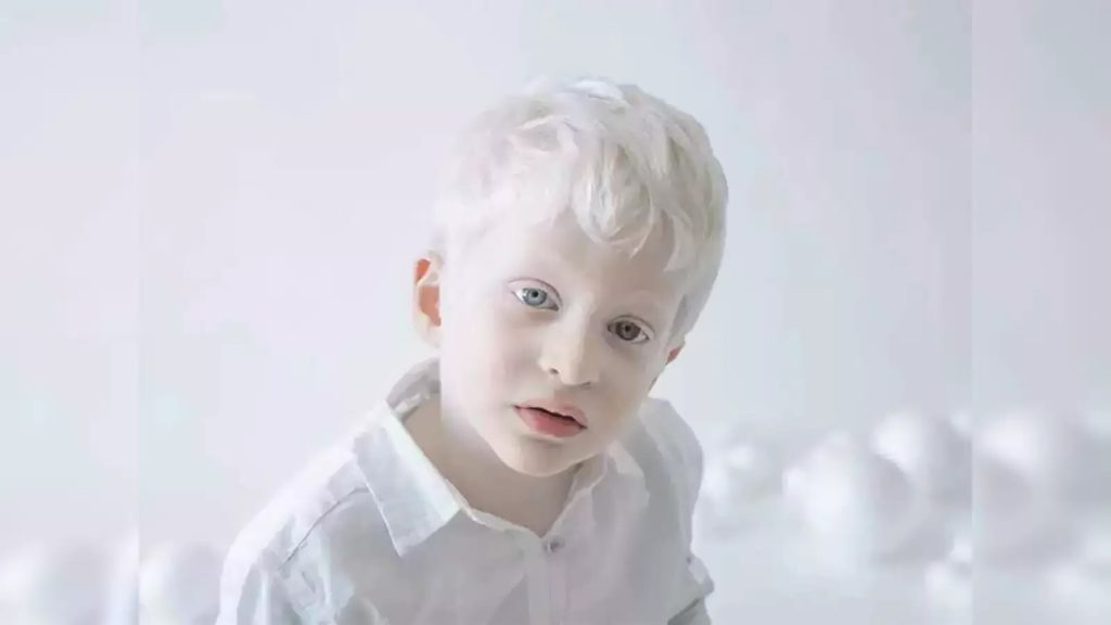 international-albinism-awareness-day-june-13