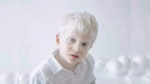 International Albinism Awareness Day June 13