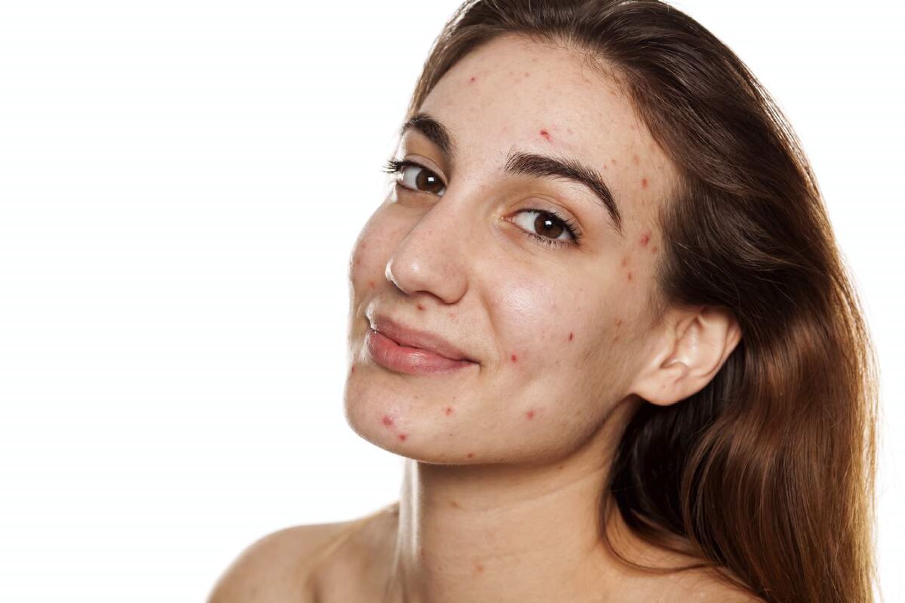 National Acne Positivity Day September 1