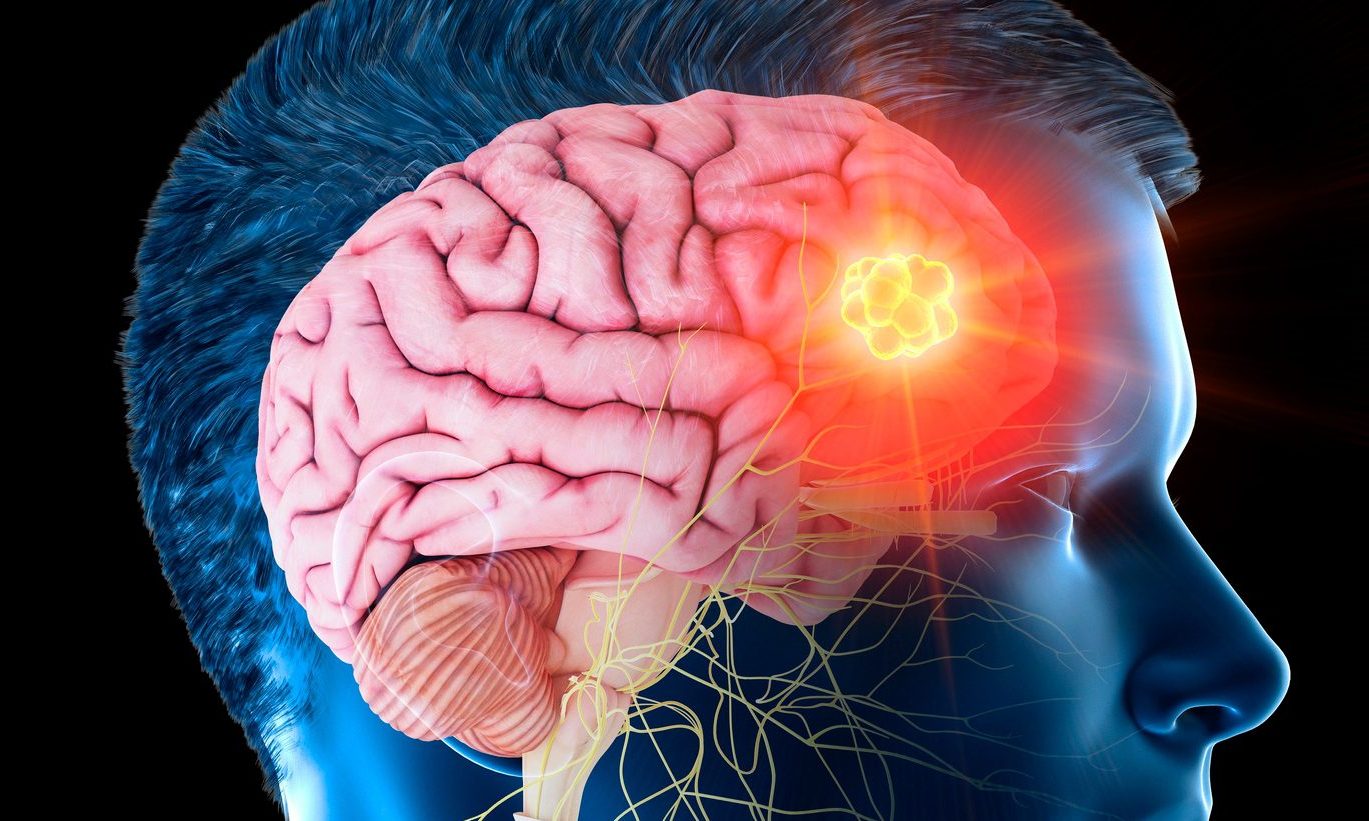 World Brain Tumor Day June 8